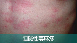 无皮疹,仅有针刺,剧痒感外,还可在躯干和肢体近端皮肤(腋,掌跖除外)